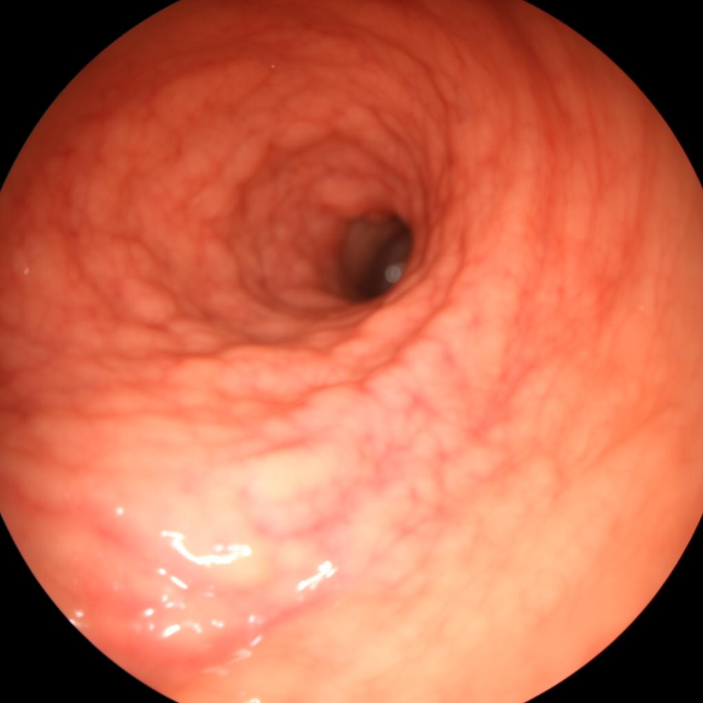 Imagem clínica — Endoscopia Digestiva Alta